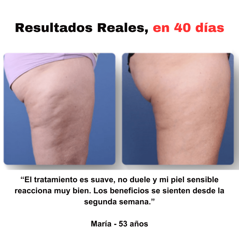 SmoothGlow™ - Masajeador anticelulítico